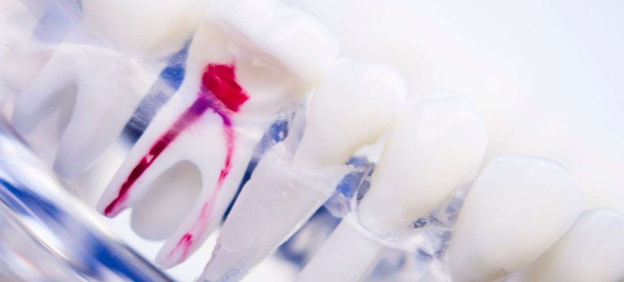 child root canal pulpotomy